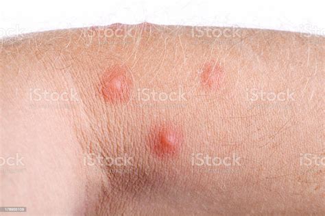 3 Raised Pimples On The Akin Of A Human Forearm Stock Photo Download