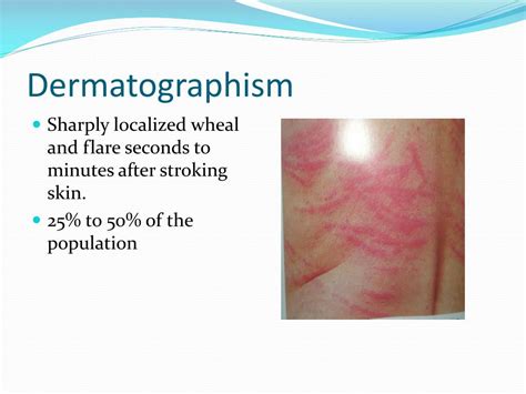 Ppt Allergy Urticaria Angioedema Shock Anaphylactic
