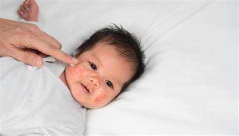 Baby Eczema Vs Acne How To Spot The Difference