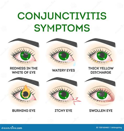 Conjunctivitis Types Inflammatory Diseases Of Eyes Cartoon Vector