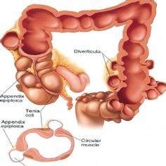Iv contrast is not usually required to make a diagnosis of diverticulitis, but can aid identifying complications and other diagnosis. Pre and Non Cancerous Bowel Conditions - The Grace Gawler ...