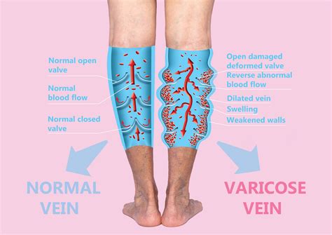 Vein Procedures We Treat Thousands Of People With Vein Disorders Yearly