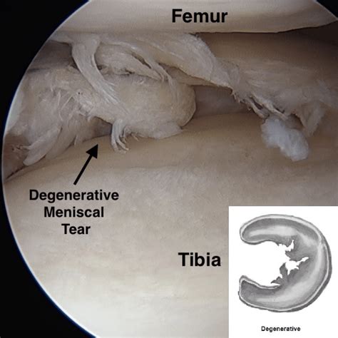 Exercise Vs Surgery For A Degenerative Meniscal Tear Yay Or Nay The