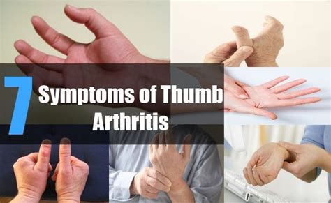 Top 7 Symptoms Of Thumb Arthritis Findarthritistreatment