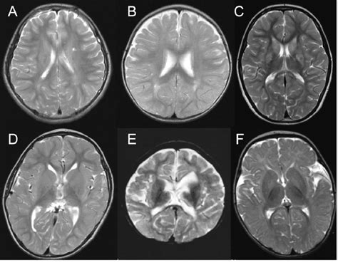 Nonspecific Brain Findings On T2 Weighted Mri A Case 5 Mild