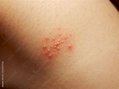 Close Up Of Girl Has Rash And Other Nonspecific Skin Eruption On Her
