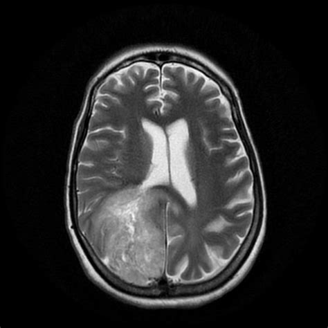 Glioblastoma Last Stages Of Glioblastoma