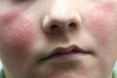 Meningitis Rash On Face