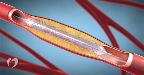 What To Expect During And After Stent Placement Oklahoma Heart Hospital