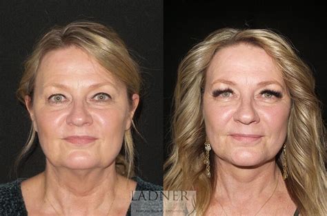 Facelift Neck Lift Before And After Pictures Case 31 Denver Co Ladner Facial Plastic Surgery