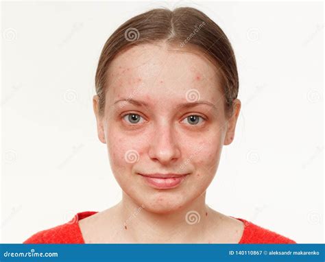 Portrait Of A Girl Without Makeup Acne On The Face Stock Image Image