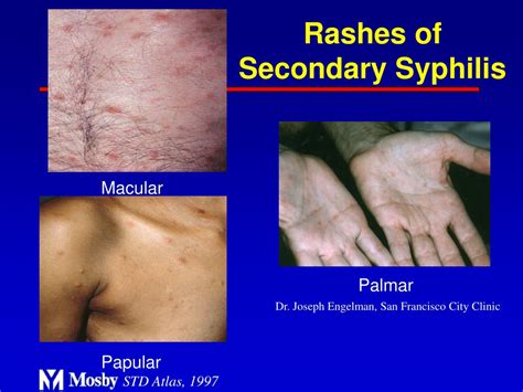 Ppt Syphilis Clinical Aspects Epidemiology And Control Powerpoint
