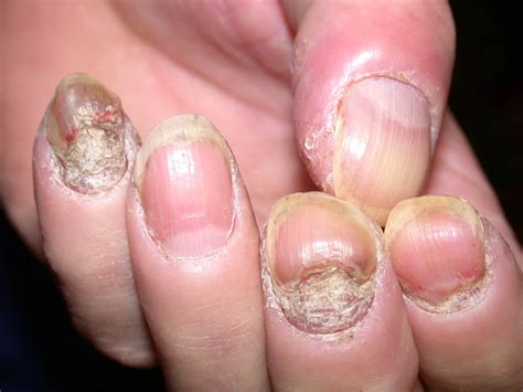 Nail Psoriasis Allergykb