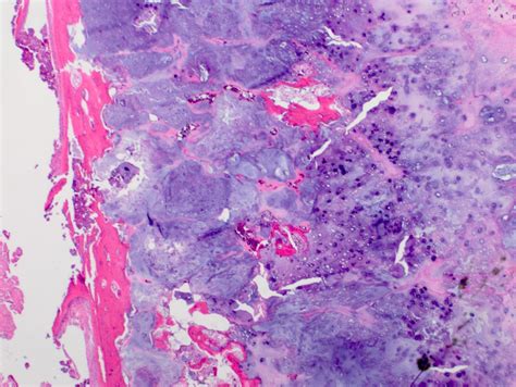 Pathology Outlines Atypical Cartilaginous Tumor Chondrosarcoma Grade 1