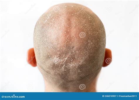 Male Bald Flaky Head With Dandruff Close Up Back View White