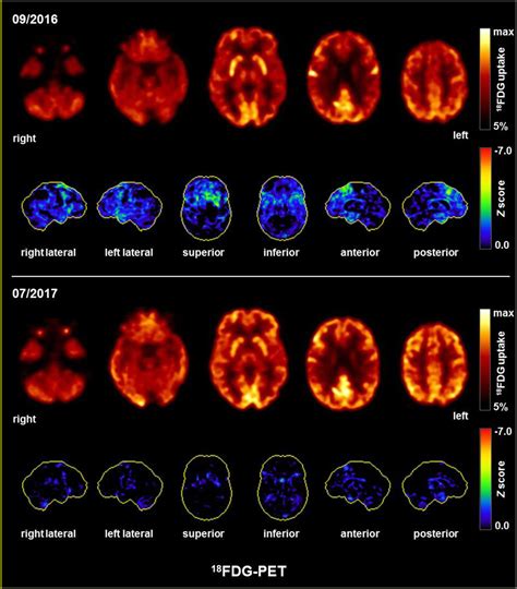 Frontiers Plasmapheresis Responsive Rapid Onset Dementia With