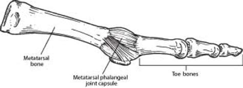 Capsulitis Of The 2nd Toe Foot And Ankle Specialists Of Middle Tennessee