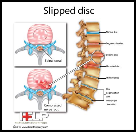 What are the symptoms of a slipped disc? Slipped Disc | Nervous System | Pinterest | Nervous system