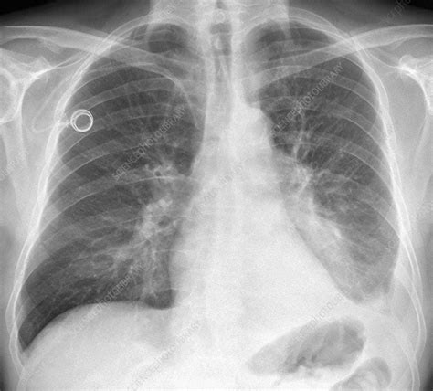 Lung Cancer X Ray Stock Image C0187149 Science Photo Library