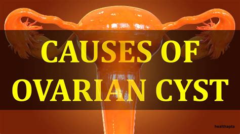 Causes Of Ovarian Cyst Youtube