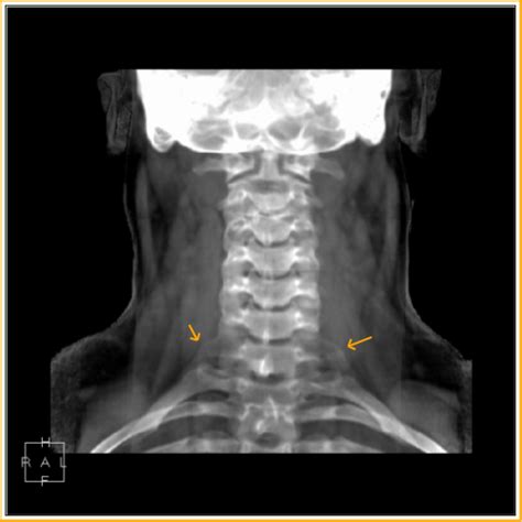 Cervical Ribs Ct Sumers Radiology Blog