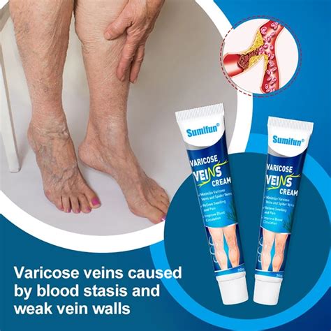 Effective Varicose Veins Relief Cream Relieve Vasculitis Phlebitis