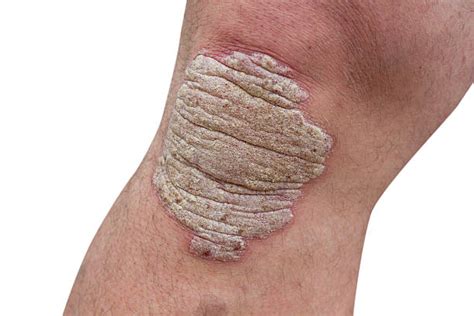 Psoriasis Knees Stock Photos Pictures And Royalty Free Images Istock