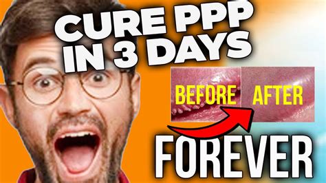 Pearly Penile Papules Removal Easy And Quickly At Home Get Rid Of PPP In Days YouTube