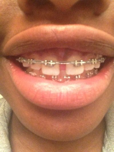 We hope this article helps you decide the best course of action for the gaps between 3.3 how can i get rid of gaps in teeth without braces? I've had braces since last year November and my gap won't ...