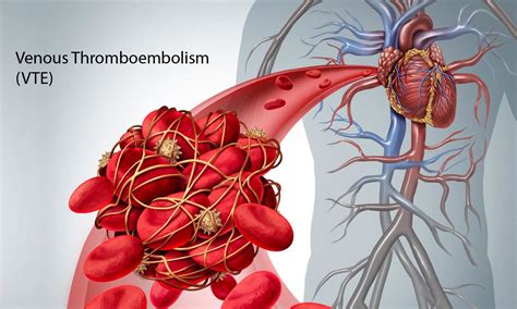 Management Of Venous Thromboembolism Dvt And Pulmonary Embolism Ash
