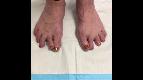 Minimally Invasive Toe Straightening And Hammertoe Surgery Upcoming Case