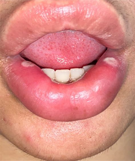 Herpes In Mouth Pictures On Tongue Bumps Underneathe Tongue Some Red Some White