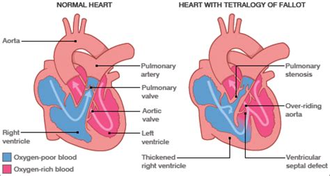 Anatomical Drawing Of Tetralogy Of Fallot Download Scientific Diagram
