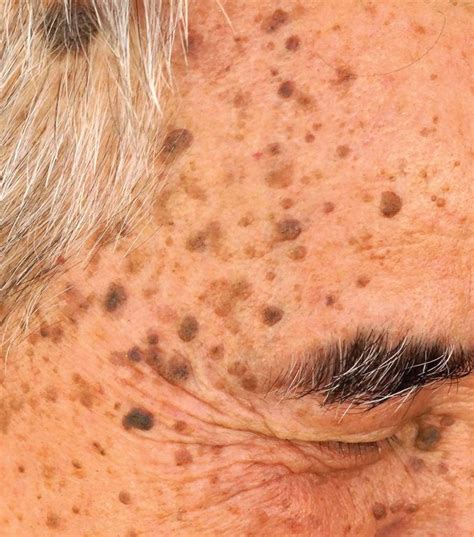 How To Get Rid Of Age Spots Naturally Age Spot Remedies Age Spot