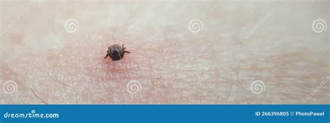 Tick Macro Photo On Human Skin Ixodes Ricinus Bloated Parasite Bitten