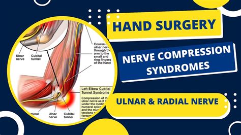Radial And Ulnar Nerve Nerve Compression Syndromes Hand Surgery Dr