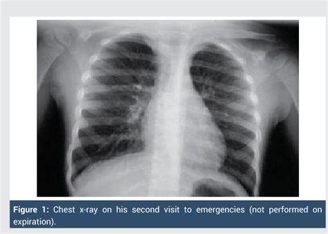 Figure 1 From Tracheal Foreign Body Importance Of Early Diagnosis