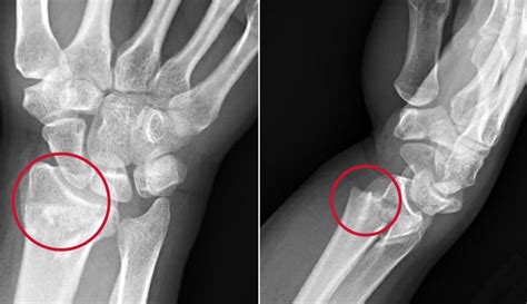 Colles Fracture Symptoms Causes And Treatment