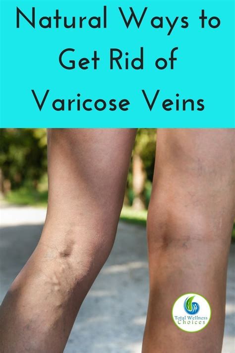12 Natural Ways To Get Rid Of Varicose Veins Varicose Veins Varicose Vein Remedy Holistic