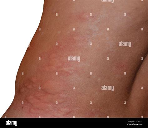 Réaction Allergique Sur La Peau Banque Dimage Et Photos Alamy