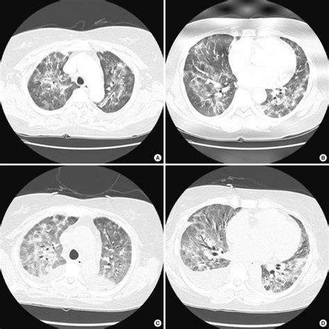 Pathology Of Transbronchial Lung Biopsy Myxoid Fibroblastic Plugs Are