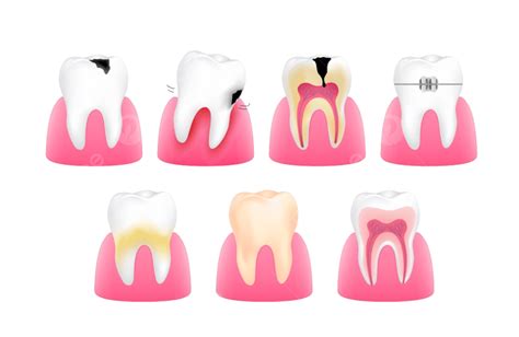 Set Of Healthy And Unhealthy Tooth Tooth Clean Of Png And Vector