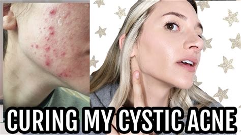 Curing My Hormonal Cystic Acne All Natural No Accutane My Story YouTube