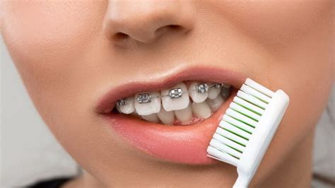 Escova De Dente Para Aparelho Como Escolher A Ideal Clinica Oraldents