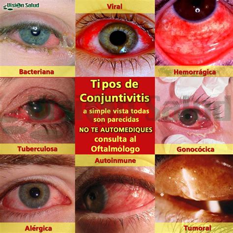 Conjutivitis Bacteriana No Te Automediques Consulta A Un Profesional