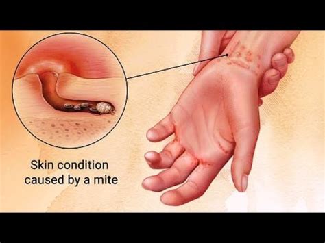 Causes Symptoms And Treatment Of Scabies YouTube