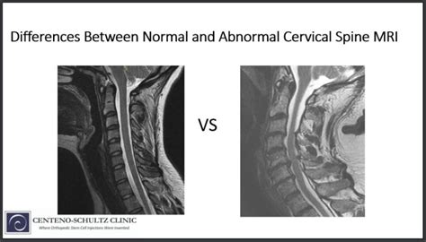 Differences Between A Normal Vs Abnormal Cervical Spine Mri
