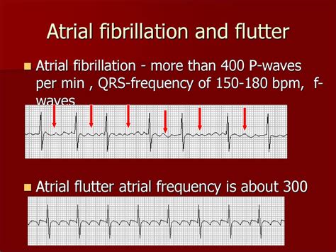 flutter vs atrial fibrillation ekg my xxx hot girl