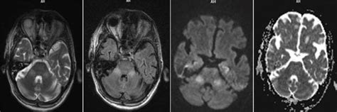 Hyperintensities On Mr Images T2 And Flair In Middle Cerebellar