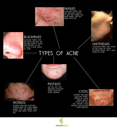 How To Recognize What Kind Of Acne You Have Innate Skin Types Of